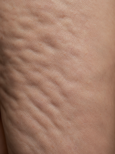Cellulite